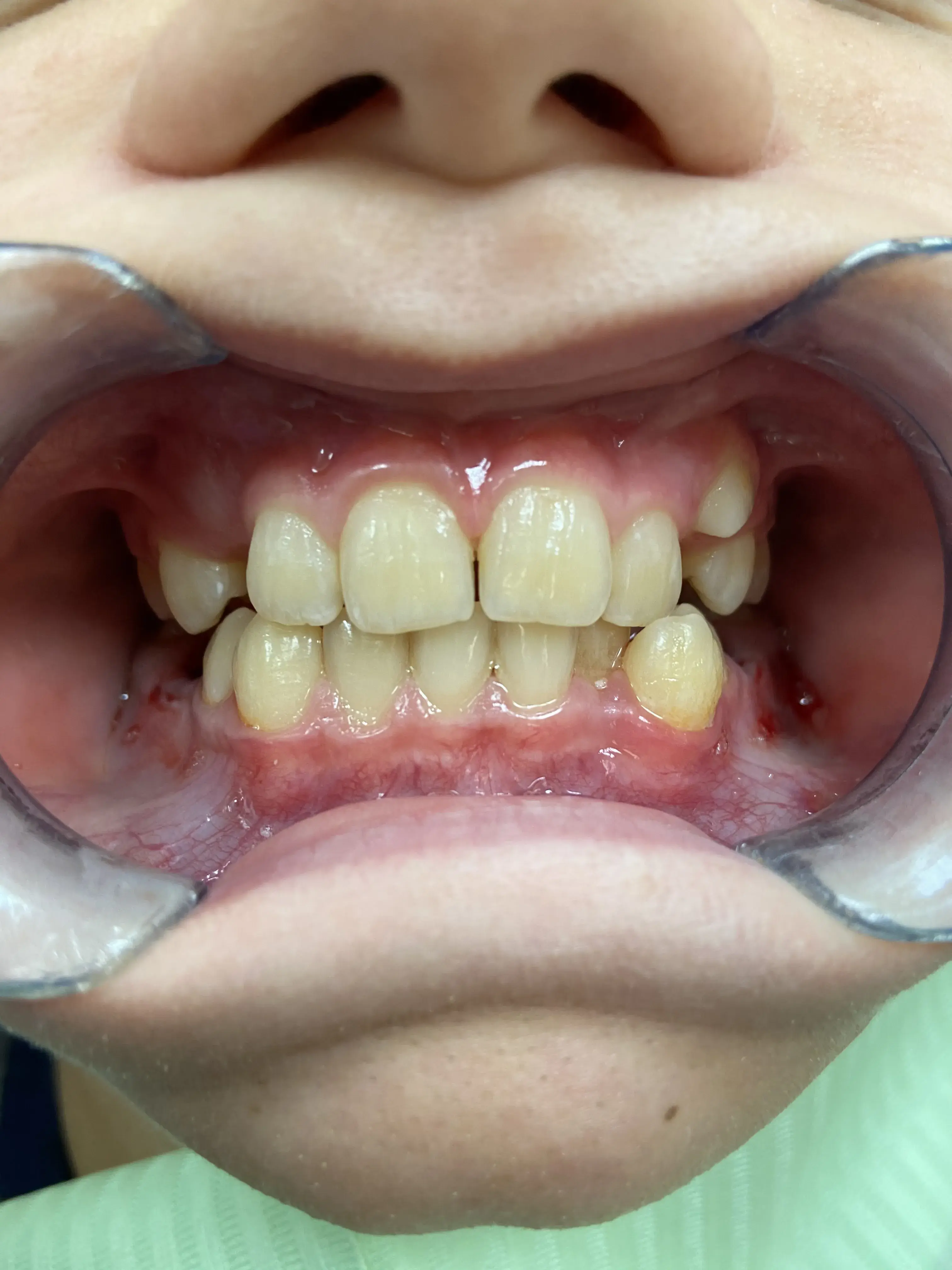 До встановлення брекетів - Sorridi Ірпінь