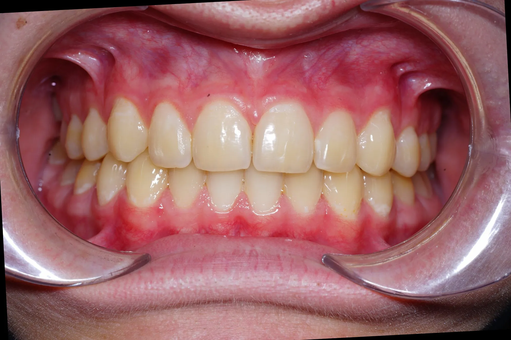 Після встановлення брекетів - Sorridi Ірпінь