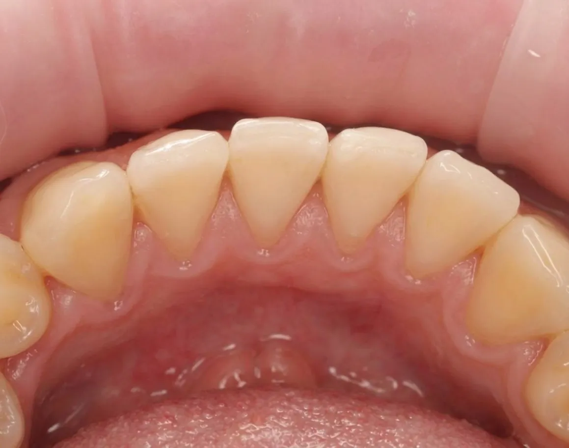 Результат професійної гігієни - Sorridi Ірпінь