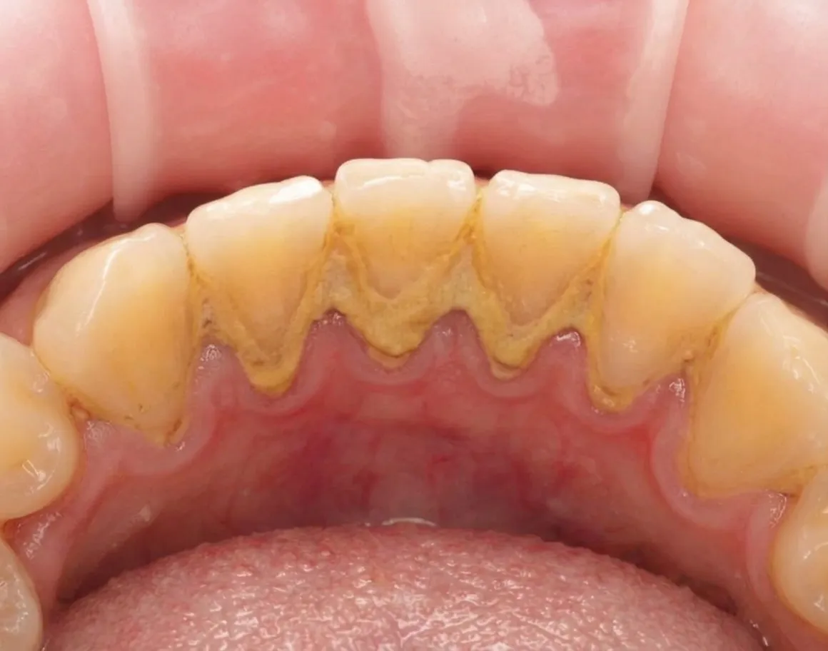 Зуби до чистки - Sorridi Ірпінь