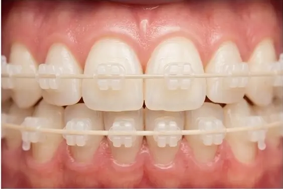 Керамічні брекети в Ірпені - Sorridi