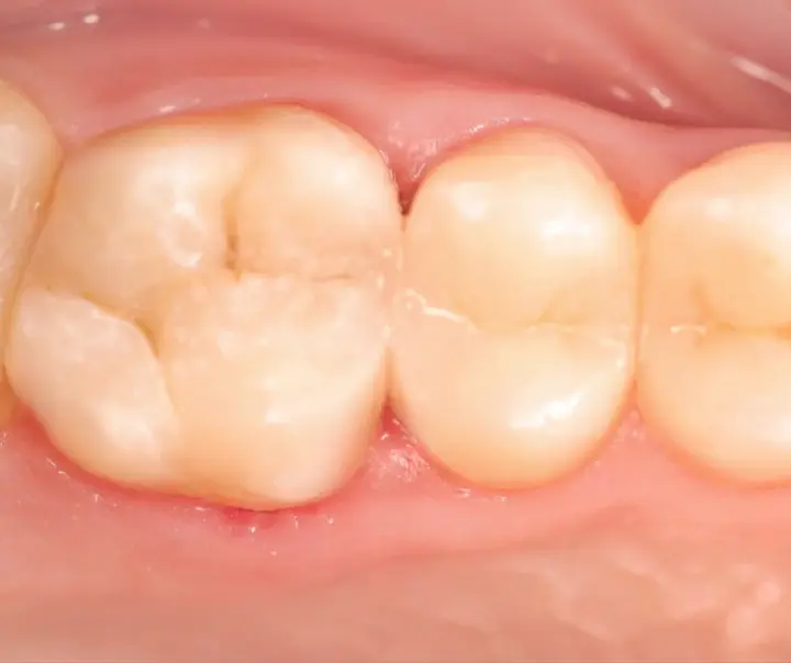 Результат лікування карієсу - Sorridi Ірпінь