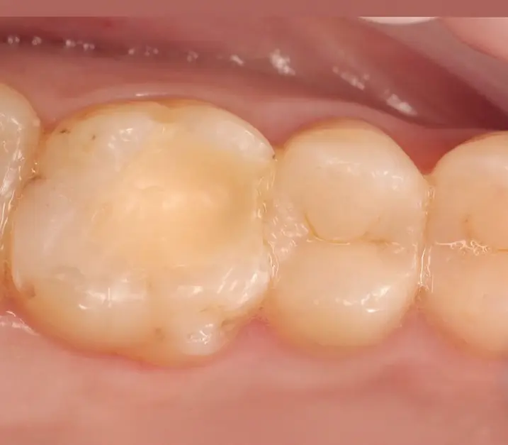 Зуби до лікування карієсу - Sorridi Ірпінь