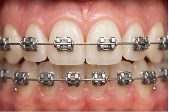 Металеві брекети в Ірпені - Sorridi