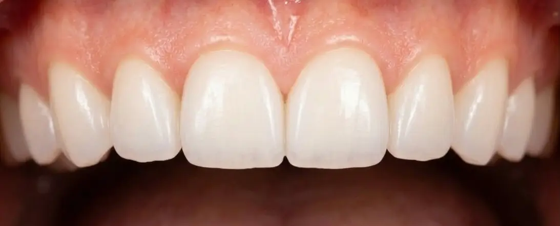 Результат художньої реставрації зубів - Sorridi Ірпінь