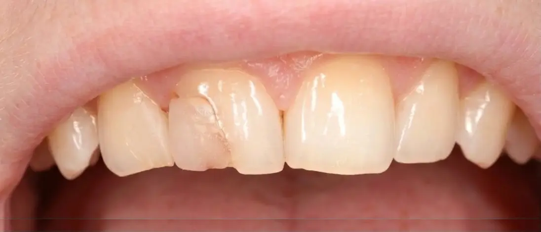 Зуби до художньої реставрації - Sorridi Ірпінь