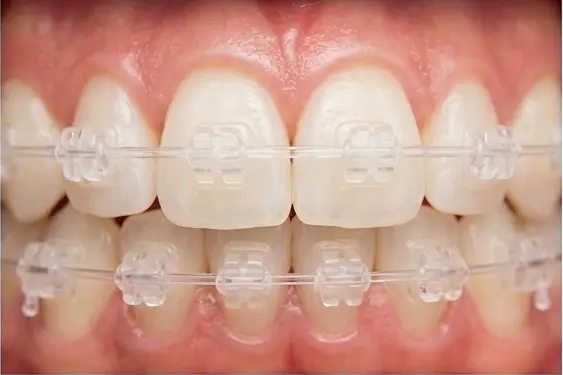 Сапфірові брекети в Ірпені - Sorridi