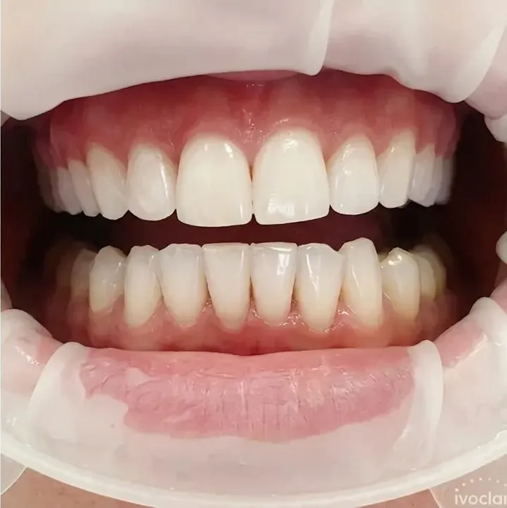 Результат відбілювання зубів - Sorridi Ірпінь