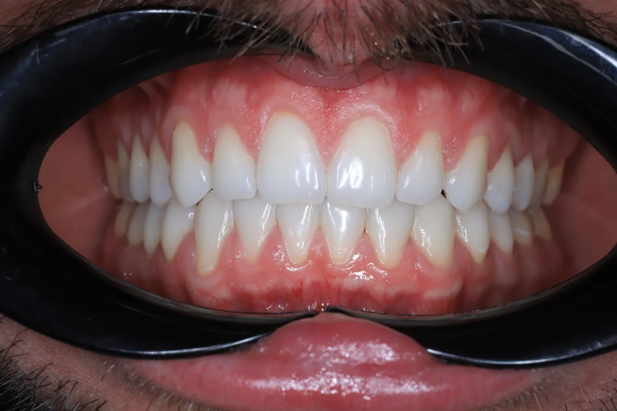 Result of home ART-10 whitening - Sorridi Irpin