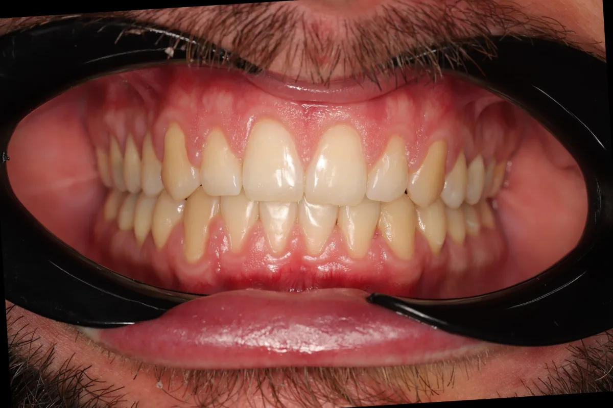 Teeth before home ART-10 whitening - Sorridi Irpin